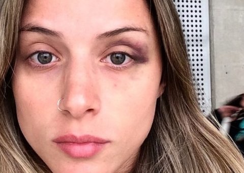  Bailarina do Faustão mostra hematomas de briga com Yuri e conta detalhes