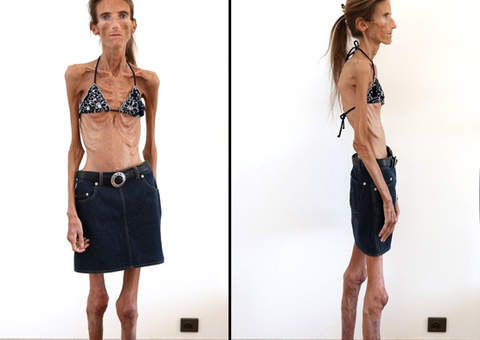  Ex-modelo com anorexia extrema diz ter fãs que querem seguir seu exemplo