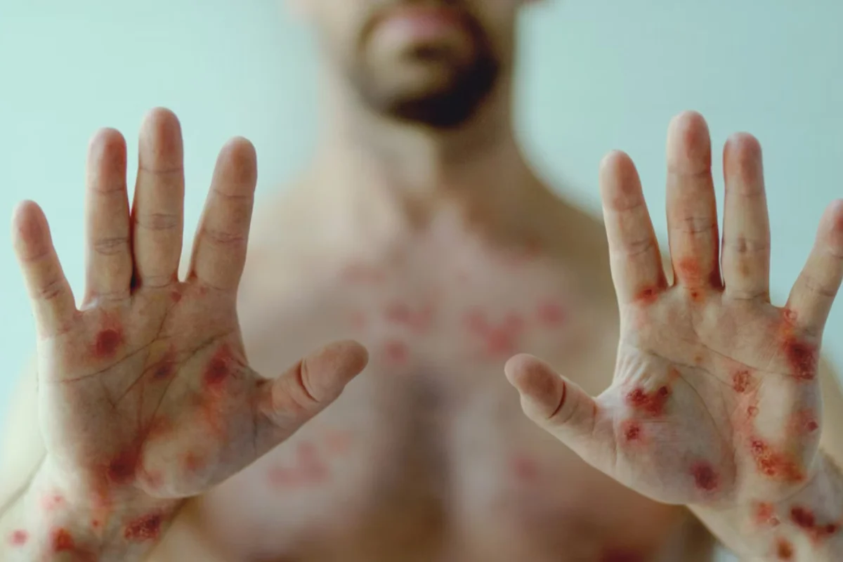 Brasil chega a 140 casos confirmados de mpox em 2026