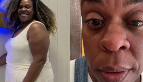 Cacau Protásio volta a enxergar após cegueira temporária e alerta sobre uso de pomada capilar