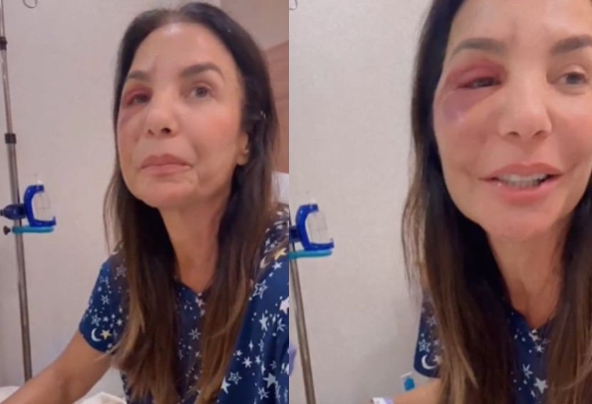 Ivete Sangalo explica acidente que fraturou dois ossos da face; vídeo