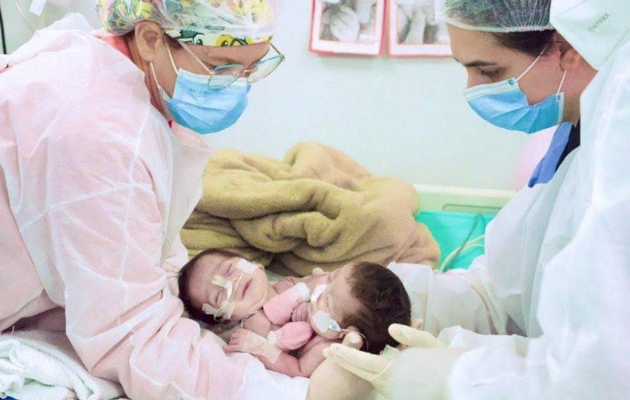 Gêmeas siamesas que nasceram em Manaus comemoram 1 ano após cirurgia complexa