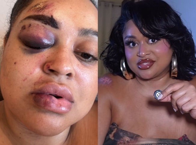 Ex-BBB Rízia Cerqueira sofre acidente grave e tem fratura no rosto