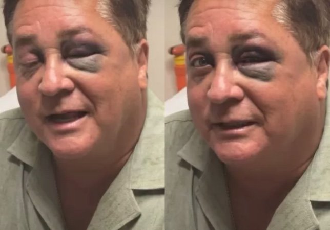 Leonardo sofre acidente no Pantanal e aparece com olho roxo; vídeo