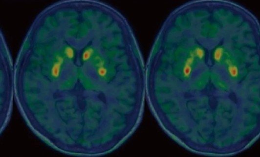 Técnica japonesa de reprogramação celular reduz sintomas de Parkinson em até 50%