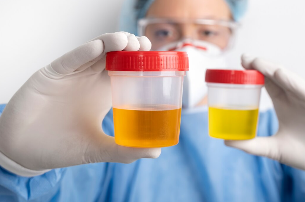O que a cor da urina diz sobre a sua saúde e quando buscar exames médicos