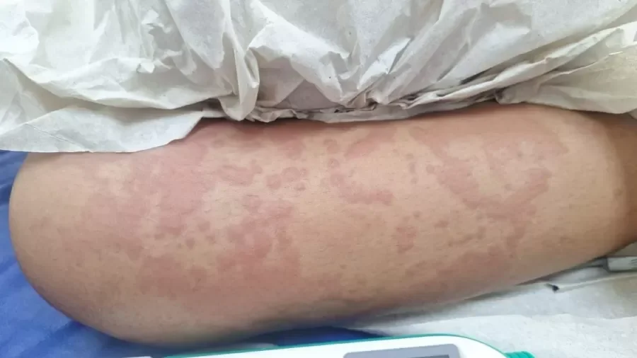 Rio Grande do Norte investiga suposto caso de intoxicação de criança por contato com produto da Ypê