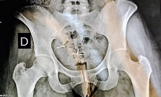 Engenheira perde útero e parte do intestino após erro com DIU