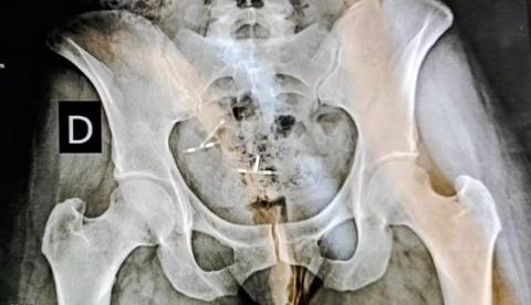 Engenheira perde útero e parte do intestino após erro com DIU