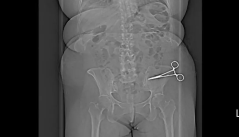 Paciente descobre tesoura de 15 cm no abdômen sete meses após cirurgia plástica