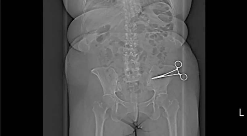 Paciente descobre tesoura de 15 cm no abdômen sete meses após cirurgia plástica