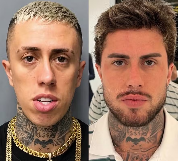MC Daniel choca com antes e depois de procedimentos estéticos