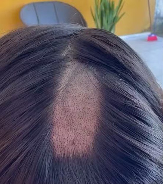 Mulher denuncia laboratório após ter cabelo raspado em exame para CNH