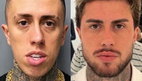 MC Daniel choca com antes e depois de procedimentos estéticos