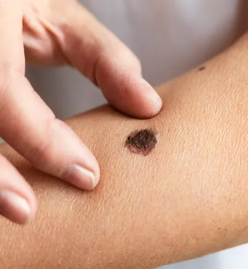 Vacina personalizada contra câncer reduz risco de retorno do melanoma em estudo