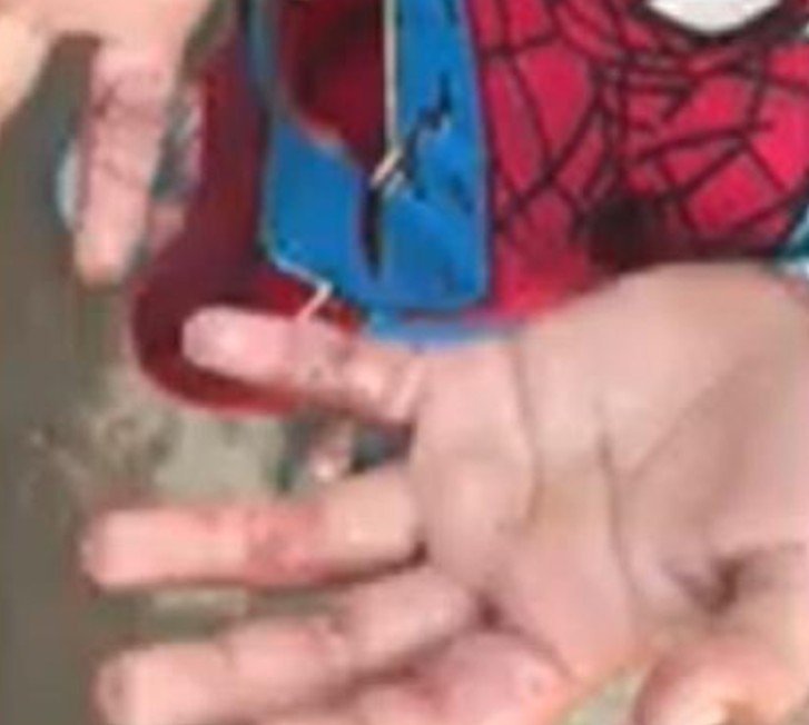 Criança de 5 anos é resgatada com queimaduras graves após suposto castigo em Manaus