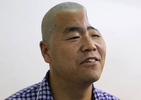 Chinês tem o crânio reconstituído com a ajuda de uma impressora 3D