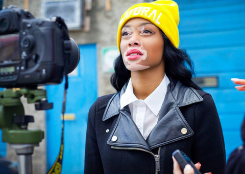 Quebrando tabus de beleza modelo com vitiligo se destaca em reality 