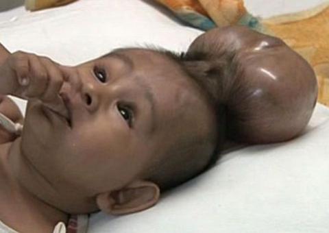 Condição rara faz bebê nascer com uma cabeça sobre a outra
