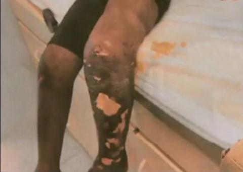 Criança faz cocô no lugar errado e pai joga água fervendo nela