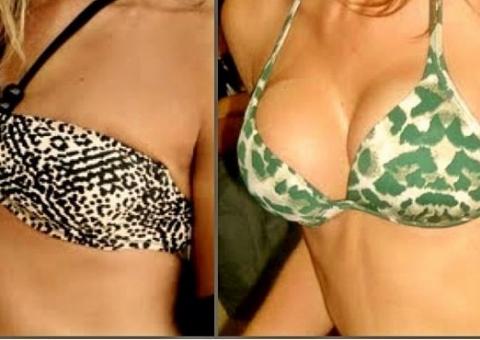  Ex-BBB Adriana mostra 'antes e depois' do silicone