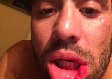 Ex-BBB Yuri mostra hematomas após ser preso por suposta agressão à namorada