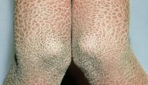 Menina fica com pele 'dura' como pedra devido a doença rara