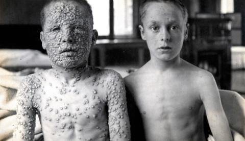 Foto chocante de irmãos com e sem varíola mostra importância da vacinação