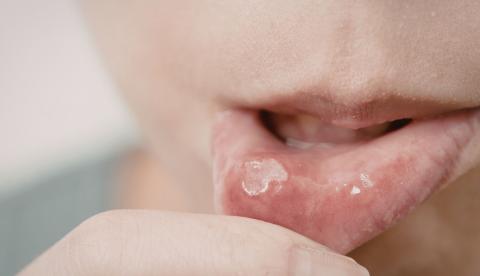 Doença do beijo e herpes: Saiba como proteger sua saúde bucal no Carnaval