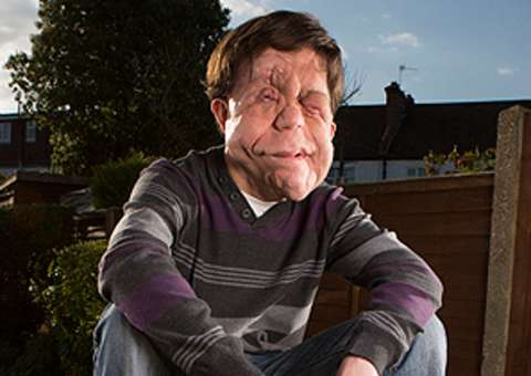 Homem com anomalia facial na vida real, atua com Scarlett Johansson 