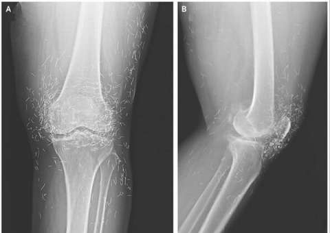 Tratamento de acupuntura transforma dor em ouro