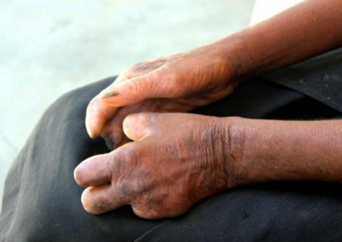 Europeus desenvolveram resistência à lepra no final da Idade Média