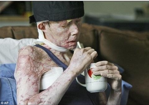 Homem queima mulher e ela sai do hospital mais bonita