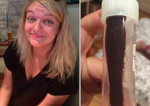 Mulher sofre hemorragia e descobre que sanguessuga morava em seu nariz 