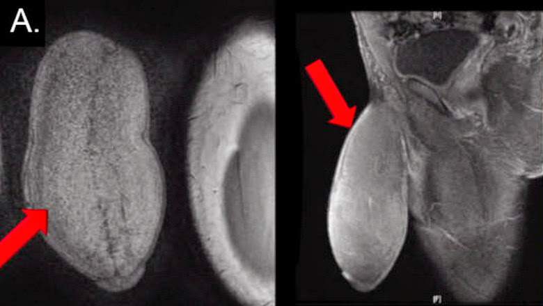  Jovem faz cirurgia para diminuir tamanho do pênis