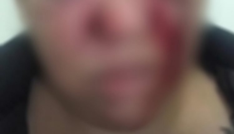 Mulher é espancada com vassouradas e tem braço quebrado por ex-marido