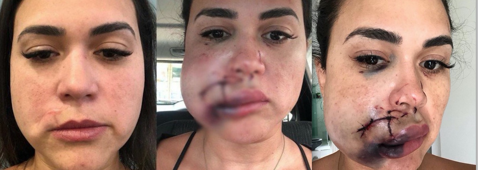 Mulher que teve rosto desfigurado por modelo em restaurante de luxo mostra reconstrução 