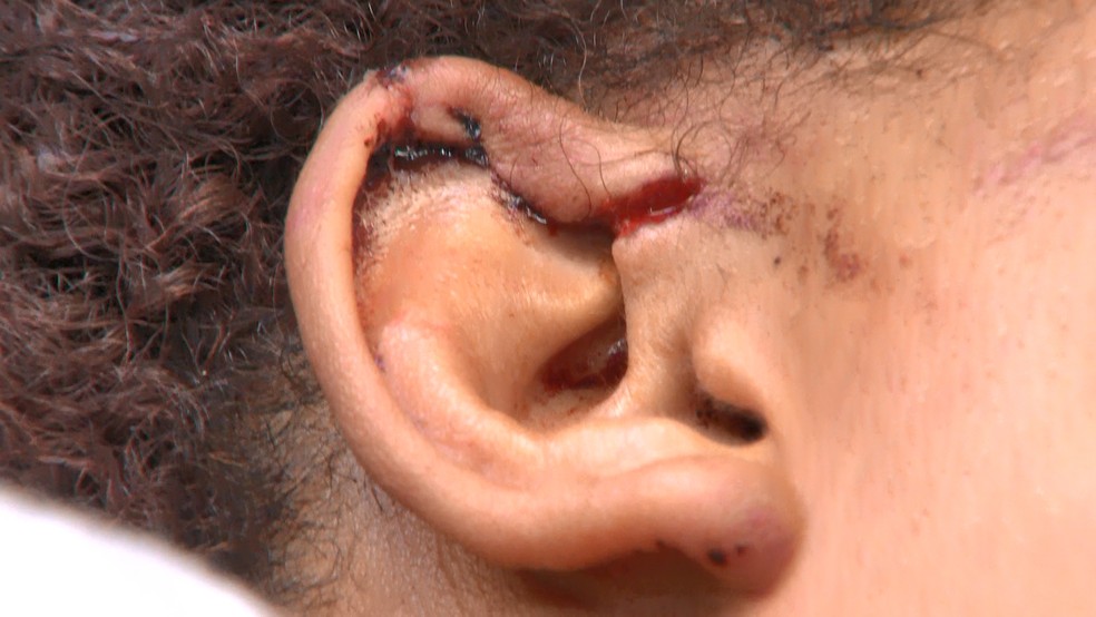 Auxiliar de serviços gerais quase tem orelha arrancada pelo namorado durante agressão