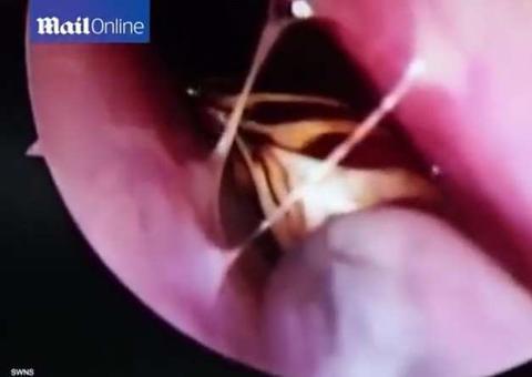 Após fortes dores de cabeça, paciente tem barata retirada do crânio