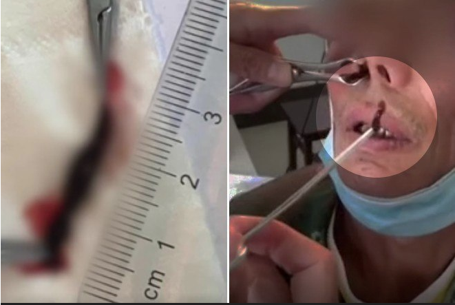 Sanguessuga é retirada do nariz de idoso; veja imagens