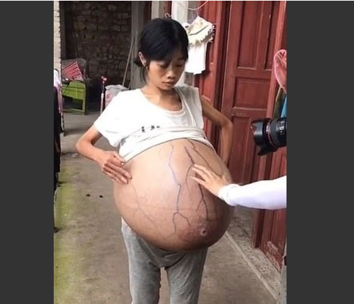 Barriga de mulher cresce misteriosamente sem parar e intriga especialistas
