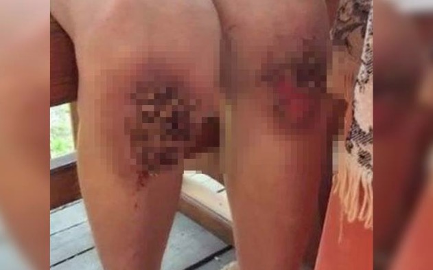 Criança fica com deformidade após ser castigada a ficar de joelhos no trigo