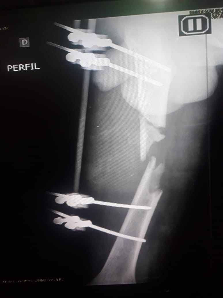 Falta de material em hospital deixa paciente sem cirurgia há quase 2 anos