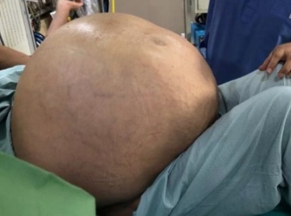 Mulher se queixa de aumento de peso e descobre tumor de 50 kg