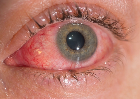  Vírus da Zika pode se esconder nos olhos