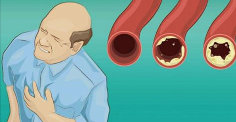 15 Alimentos que limpam artérias naturalmente e evita infarto