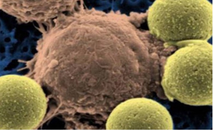 Novo e arriscado tratamento tem remissão em 82% de pacientes com leucemia