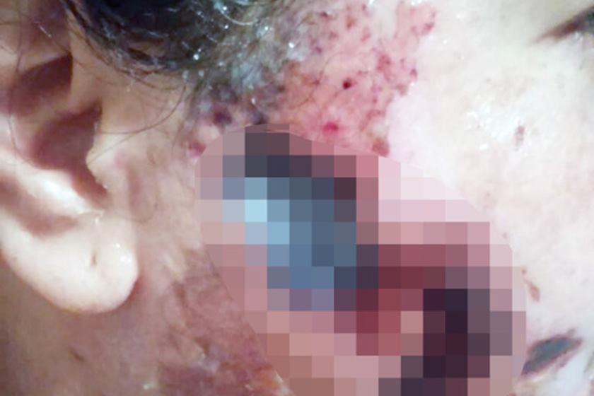 Mulher se recusa a voltar com ex e acaba com rosto desfigurado 