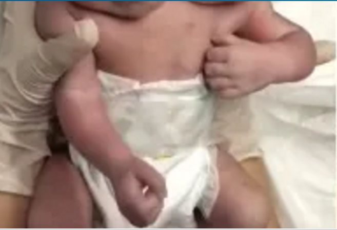 Bebê nasce com duas cabeças não resiste e morre; Vídeo