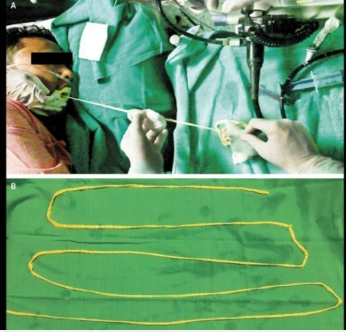 Médicos tiram verme de quase dois metros pela boca de paciente